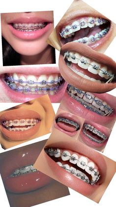 Maroon Braces Teeth, How To Get Braces, Powerchain Braces Color, Light Pink Braces, Braces Navy Blue, Brackets Aesthetic, Light Blue Braces