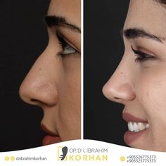 Iranian Nose Job Before And After, Nose Job Inspiration Rhinoplasty, Nose Job Droopy Tip, Nose Jobs Inspiration, Good Nose Jobs, Cute Nose Job, Natural Looking Nose Job, Nose Inspo Rhinoplasty