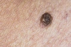 Types Of Warts, Red Moles, Remove Skin Tags Naturally, Warts Remedy, Remove Warts, Skin Moles, Mole Removal, Get Rid Of Blackheads, Neem Oil