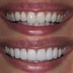 Teeth Makeover, Perfect Smile Teeth, Composite Bonding, Teeth Aesthetic, Pretty Teeth, Veneers Teeth, Aesthetic Dentistry, Teeth Whitening Remedies, Beautiful Teeth