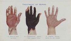 four different types of hands with the words treatment of burns on them