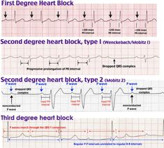 Emt Study, Medicine Notes, Heart Blocks