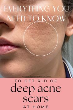 how to get rid of deep acne scars guide Something Is Wrong With Me, Acne Scar Remedies, Scar Remedies, Poreless Skin, Beauty Ads, Types Of Acne, Acne Scar Removal, Luscious Hair, Beauty Ad