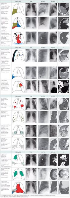 an image of the chest with different types of lungs and their corresponding functions in each region