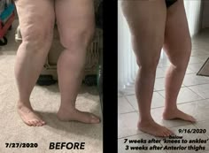 Lipedema Legs, Lymph Drainage Massage, Brazilian Buttlift, Drainage Massage, Lymph Massage, Lymph System, Surgery Center