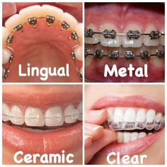 Lingual Braces, Natural Teeth Whitening Diy, Ceramic Braces, Types Of Braces, Braces Tips, Getting Braces, Partial Dentures, Teeth Whitening Diy