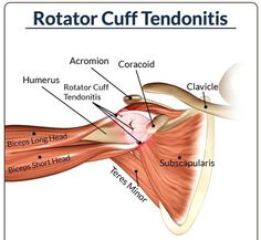 What is tendonitis? Tendonitis is an inflammation or irritation of a tendon that is most often caused by repetitive, minor impact on the affected area, or from a sudden more serious injury. Our physical therapy treats this condition, so give us a call if you need an appointment! (908) 224-0870 Human Body Anatomy, Massage Benefits, Rotator Cuff