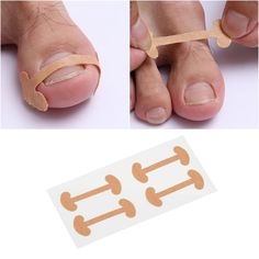 *FREE Nail Clipper with every order! Limited Time. 20 pieces Ingrown Toenail Tape Correction Tape Stickers provide for you, enough quantity that allows you to use, replace and share. Material: Waterproof and breathable, it can be worn normally. Easy to use: Remove the sticky surface and place it on your toes. And skin tone design, comfortable and invisible. Function: Paronychia Toenail Treatment Tape Recover Corrector effective treatment to protect the toenails. Reduce the pain oppressive feelin Tape Stickers, Pretty Sandals, Correction Tape, Brittle Nails