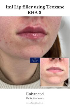 We used Teoxane RHA 3 to provide the patient with a natural, well defined shape. We pride ourselves in maintaining the natural shape of the lip - so no overfilled lips here! We are located in Larbert, Scotland. Appointments can be booked at www.enhancedfacial.co.uk Overfilled Lips, The Patient