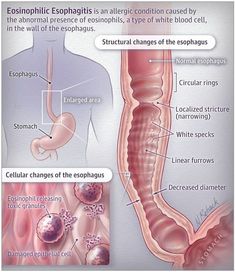 Eosinophilic Esophagus Diet, Esophagus Problems, Eosinophilic Esophagus, Esophageal Spasm, Nursing School Studying, Nursing Notes