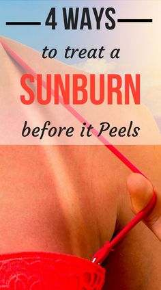 Sunburn On Face, Sunburn Face, Sunburn Blisters, How To Help Sunburn, Get Rid Of Sunburn, How To Treat Sunburn, Sunburn Peeling