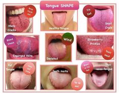 Healthy Tongue, Tcm Traditional Chinese Medicine, Foot Detox Soak, Health Signs, Traditional Chinese Medicine, Reflexology, Chinese Medicine