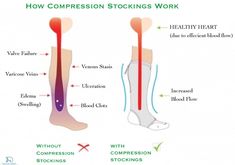 Compression stockings Vein Thrombosis, Leg Compression, Body Aches, Water Aerobics, Scrub Life