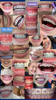 🥰😛☺️😊🥸 Pretty Teeth, Cute Braces, Diamond Teeth