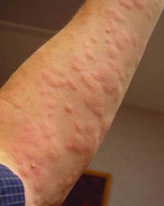 Allergic Reaction Rash, Hives Rash, Hives Remedies, Allergy Rash, Chronic Hives, Sun Allergy, Home Remedies For Skin, Skin Allergies, Allergic Reaction