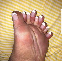 a woman's hand with white and pink nail polishes on her nails, resting on a yellow stripped bed sheet