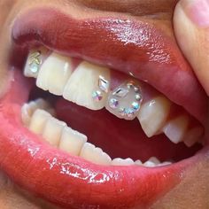 a woman's mouth with white teeth and clear braces on top of it