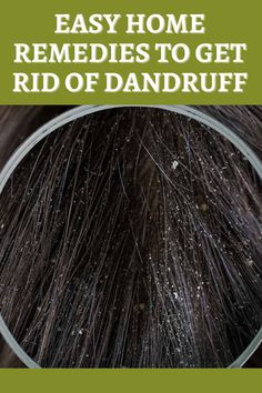 How to get rid of dandruff at home Dandruff Shampoo Best, Lemon For Dandruff, Scaly Scalp, What Causes Dandruff, Best Shampoo For Dandruff, Best Anti Dandruff Shampoo, How To Remove Dandruff, Severe Dandruff, Listerine Mouthwash