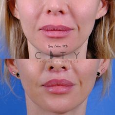 No Make Up, Best Plastic Surgeons, Facial Fillers, Facial Plastic Surgery, Facial Plastic