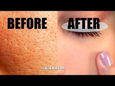 How to Make Pores Disappear! | Use 2 elements to reduce pores and have a clean face - YouTube Get Rid Of Big Pores On Face, How To Clean Pores, Huge Pores, Smooth Skin Face, Get Rid Of Pores, Asian Store, Big Pores, Nose Pores, Pore Mask