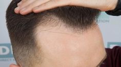 A1Services Ph. 9873310062 - Get Advanced Affordable Top 5 Hair Transplant Cilinic Near Me Delhi that works with the best clinic in Delhi. Painless & Quick Procedure with successful sessions. Affordable Top 5 Hair Transplant Cilinic Near Me Delhi is done to add more hair to an area on your head that may be thinning or balding. Affordable Top 5 Hair Transplant Cilinic Near Me Delhi Offers. Affordable Top 5 Hair Transplant Cilinic Near Me Delhi. Hair Implants, Going Bald, Bald Heads, About Hair