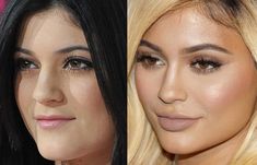 modifications Kylie Jenner Plastic Surgery, Nose Aesthetic, Surgery Nose, Lipo Before And After, Nose Jobs, Aesthetic Surgery, Hair Implants, Nose Surgery, Robert Kardashian