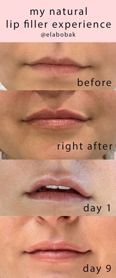 One Syringe Of Juvederm Lips, Natural Looking Lip Fillers Before And After, Lip Fillers Healing Process, Lip Filler On Small Mouth, Natural Lip Injections Before And After, Mini Lip Filler Before And After, Healed Lip Filler, Lip Filler Recovery, .5ml Vs 1ml Lip Filler