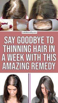 She Had Very Thin Hair, But She Used This Ingredient And Got Thick Hair Within A Week Herbal Health, Health Essentials, Thick Hair Remedies, Get Thicker Hair, Castor Oil For Hair, Hair Trim