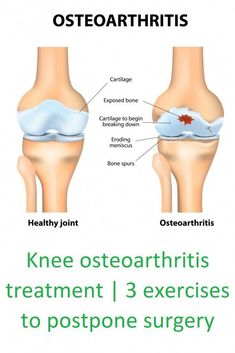 Knee osteoarthritis cause, symptoms, and treatment with 3 exercises. Improve the strength and mobility of your knee to postpone surgery Exercises For Arthritic Knees, Knee Replacement Exercises, Knee Pain Stretches, Knee Pain Relief Remedies, Knee Pain Relief Exercises, Knee Pain Remedy, Swollen Knee