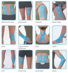 Kinesiology Tape	Kt Tape	Kinesio Tape	How To Tape With X-Spider Kt Tape	How to Tape Multiple X-Spider	X-Spider Application	X-Spider for Muscle Strain Elbow Pain, Sports Tape, Kinesiology Taping, Knee Pain Relief, Athletic Training, Medical Knowledge, Trening Abs, Sports Medicine