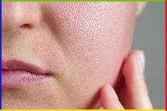 Flawless skin is characterized by less open pores. These are small pits, often found on the skin of combination to oily type and make the face appear dull. Minimize Pores Naturally, Skin Reference, Healthy Face Skin, Get Rid Of Pores, Big Pores, How To Reduce Pimples, Home Remedies For Skin, Face Pores, Oily Skin Care Routine