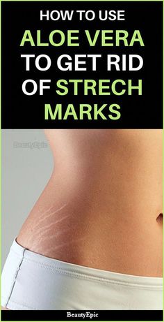 Strech Marks, Stretch Mark Remedies, Brown Spots On Skin, Acne Prone Skin Care, Brown Spots Removal, Stretch Mark Removal, Brown Spots On Face, Natural Sleep Remedies, Spots On Face