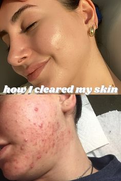 Acne can be a  journey, and a long rough one. In this video I talk about my acne journey and for anyone who might be going through the same thing I went thro... Honey And Cinnamon Face Mask, Cinnamon Face Mask, Diy Face Mask For Acne, Acne Journey, Acne Positivity, Treatments For Acne, Face Mask Acne, Face Mask For Acne, Mask For Acne