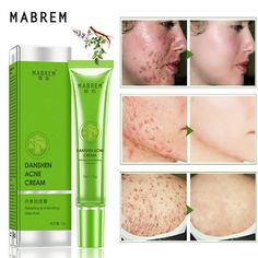 MABREM Repair Acne Cream Extract Acne Removal Scars Marks Treatment Facial Feature: Contains Danshen mild acne ingredients Refreshing and not greasy, easy to absorb non-greasy, clean pores greasy, soothes acne muscles Replenishes skin with nutrients and moisture, improves skin dryness and roughness Finely condenses pores Leaves skin supple and smooth, showing Fine and shiny. Describe: Name: Acne removing cream Net:15g Weight:35g Size of box:12x3x3.5 cm INGREDIENT:WATER,PROPYLENE GLYCOL,CETEARYL Best Acne Scar Removal, Mild Acne, Acne Removal, Natural Acne Remedies, Acne Oil, Acne Scar Removal, Acne Facial, Acne Cream, Moisturizer For Oily Skin