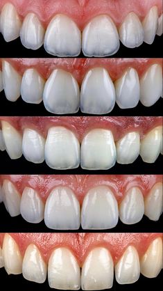 Teeth Morphology, Dental Assistant Study, Teeth Anatomy, Dental Images, Dental Anatomy, Aesthetic Dentistry, Dental Technician, Dental Laboratory