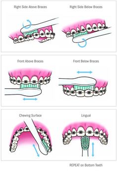 Dental Braces Colors, Braces Food, Cute Braces Colors, Braces Tips, Getting Braces, Cute Braces, Kedokteran Gigi, Brace Face, Braces Colors