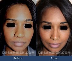 Nostril Reduction Before And After, Ethnic Nose Job, Nostril Reduction, Cosmetic Aesthetic, Body Surgery, Nose Jobs, Nasal Septum