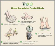 Cracked Heel Remedies, Heal Cracked Heels, Dry Cracked Heels, Dry Heels, Top 10 Home Remedies, Sugar Scrub Diy, Cracked Heels, Coconut Oil For Skin, Headache Relief