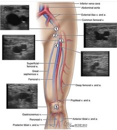 Vascular Ultrasound Notes, Lower Extremity Venous Ultrasound, Ultrasound Physics Spi, Ultrasound Technician Student Notes, Ultrasound Technician Student, Sonography Humor, Vascular Sonography, Ultrasound Humor