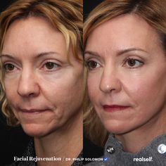 Lower Facelift Before And After, Deep Plane Facelift Before And After, Facelift Recovery, Lower Face Lift, Deep Plane Facelift, Facelift Before And After, Liquid Facelift, Facelift Procedure, Facial Procedure