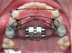 Dental Ceramics, Dental Assistant Study, Myofunctional Therapy, Dental Hygiene Student, Dentist Logo, Orthodontic Appliances, Dental Life, Orthodontics Braces