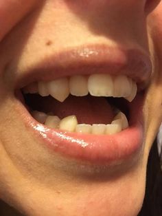 Teeth Fangs Natural, Cat Fangs, Teeth Aesthetic, Pretty Teeth, Dental Impressions, Canine Tooth, Heat Rash, Vampire Teeth, Natural Teeth Whitening