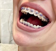 Aesthetic Teeth, Braces Bands, Ceramic Braces, Braces Cost