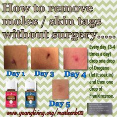 Remove Moles, Mole Removal, Yl Oils, Oil Remedies, Oregano Oil, Skin Tags