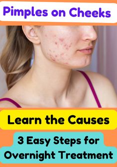 Wondering what causes pimples on your cheeks? Learn the reasons behind cheek acne and follow these 3 easy steps for an effective overnight treatment to clear your skin.
#CheekPimples
#OvernightTreatment
#ClearSkin
#PimplesSolutions
#AcneHelp
#HealthySkin
#SkinCareTips
#BeautyHacks
#AcnePrevention
#PimpleTreatment
#NaturalRemedies
#DIYSkincare
#OvernightRemedies
#SelfCare
#SkinHealth Acne On Cheeks, Causes Of Pimples, Cheek Pimples, What Causes Pimples, Cheek Acne, Overnight Remedies, Pimple Causes, Clear Your Skin, Pimples Overnight