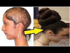 Hair Growth Remedy, Hairloss Solution, Super Hair Growth, Thicker Hair Naturally, Best Hair Growth, Hair Growth Formula, Rapid Hair Growth, Onion For Hair, Extreme Hair Growth