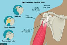 Shoulder Pain At Night, Shoulder Pain Remedies, Joints Anatomy, Shoulder Anatomy, Sore Shoulder, Shoulder Pain Relief, Frozen Shoulder, Stem Cell Therapy