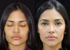 #plasticsurgery #plasticsurgerygonewrong #beforeafter #celebritiesbeforeafter #hollywoodstars #bignosesurgery #surgery #facesurgery #vlinesurgery #koreanplasticsurgery #kpopplasticsurgery #nosejob #jawreductionsurgery #eyesurgery #cheekfillers #rhinoplasty #facelift #plasticsurgeryfails #expensiveplasticsurgery Jaw Reduction Surgery, Ethnic Rhinoplasty, Face Fillers, Face Surgery