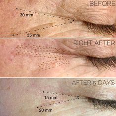 Microblading Lips, Medical Esthetician, For Skin Tightening, Skin Needling