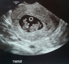 a black and white photo of a breast with the word twins on it's side